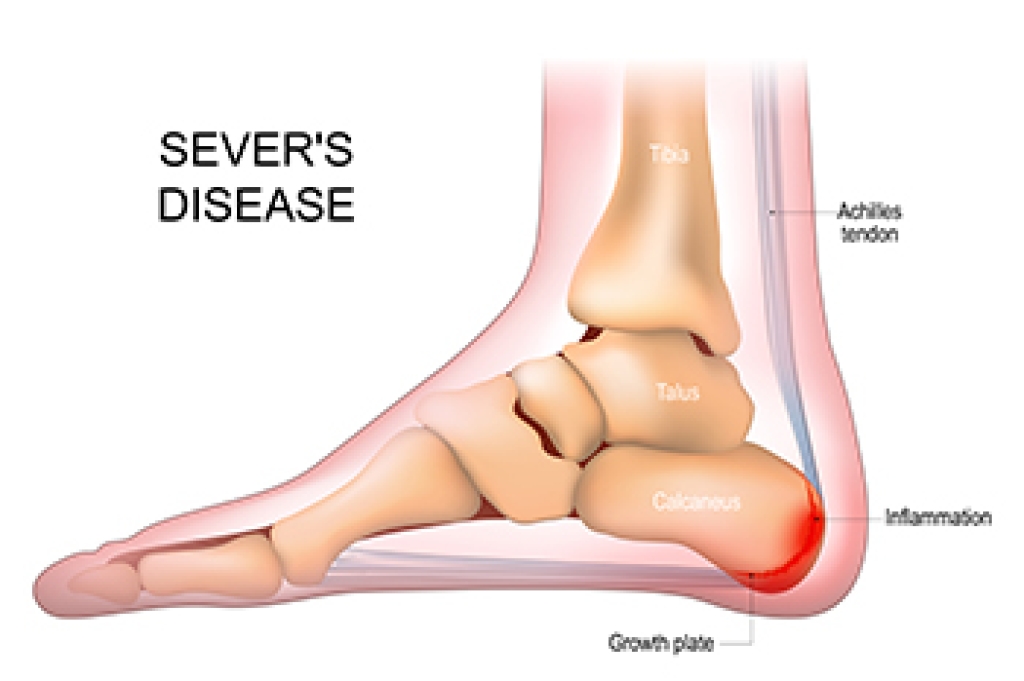 Why Active Children Develop Sever’s Disease