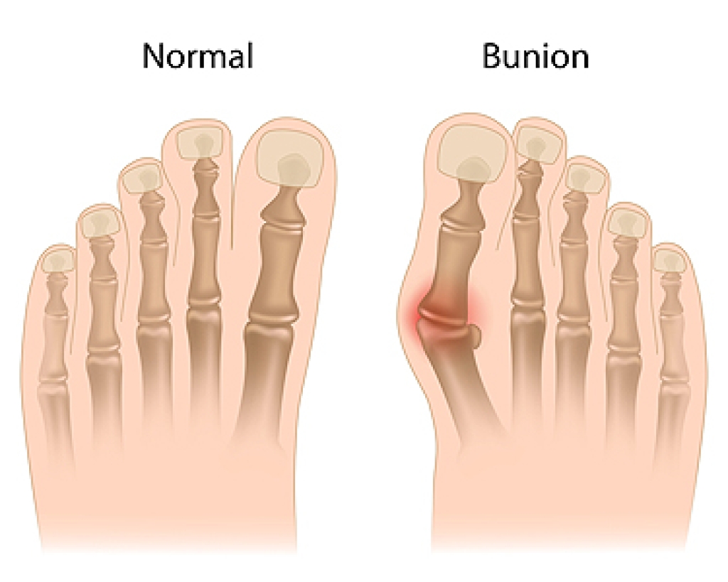 Podiatry Treatment for Painful Bunions
