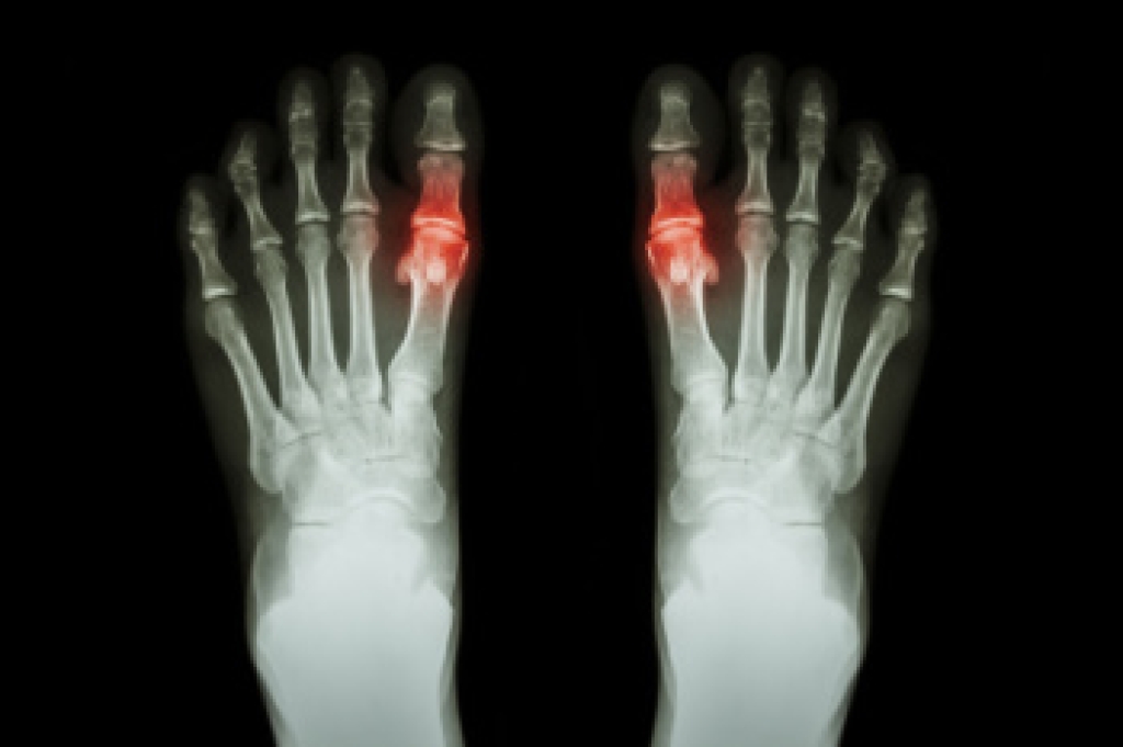 Gout and Foot Pain