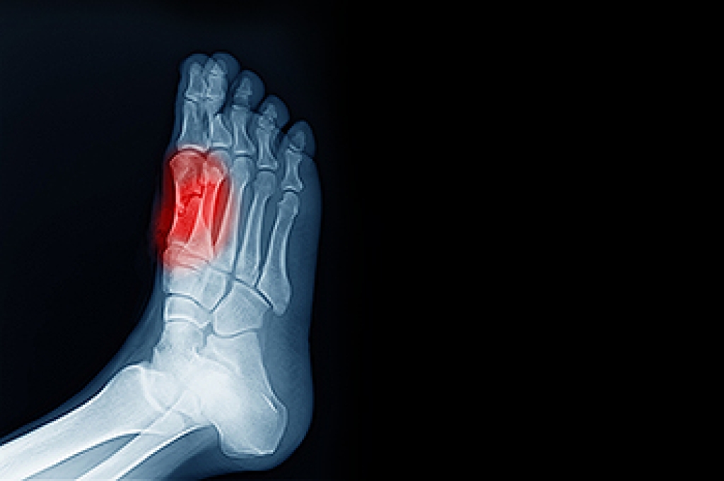 Treating Sesamoiditis Without Surgery