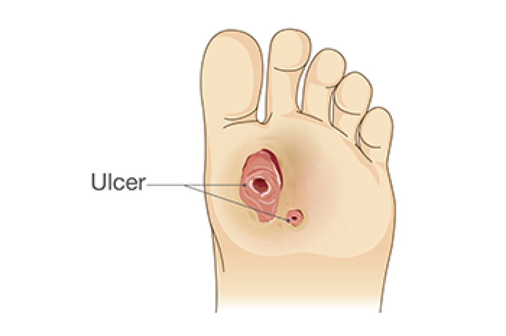 Diabetic Foot Ulcers and the Importance of Early Care