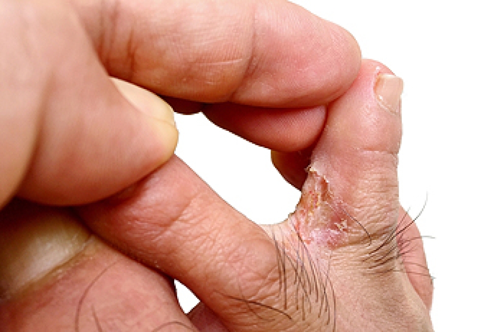 Signs of Athlete’s Foot and When to See a Podiatrist