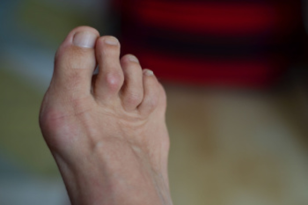 Hammertoe and Treatment From a Podiatrist