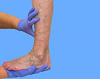 venous insufficiency