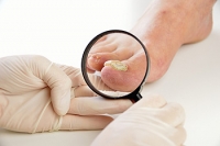 Medications for Fungal Toenail Infections