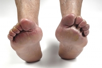 Understanding Rheumatoid Arthritis in the Feet