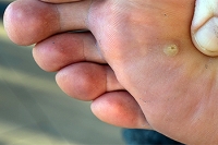 Definition and Risk Factors of Plantar Warts